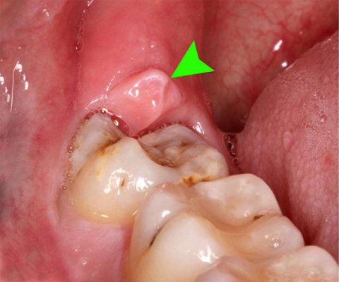 Diş əti ağrısını anında kəsir 