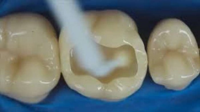 Diş ağrısını 1 dəqiqəyə yox edən təbii üsullar