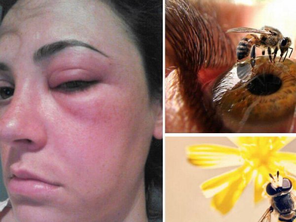 Pasiyentin gözündən 4 diri arı çıxarıldı – Tibbdə şok