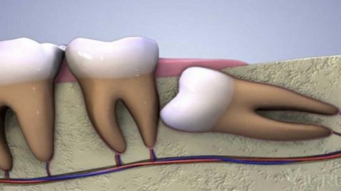 Amerikalı alimlərdən XƏBƏRDARLIQ: “Ağıl dişlərini çəkdirməyin” 