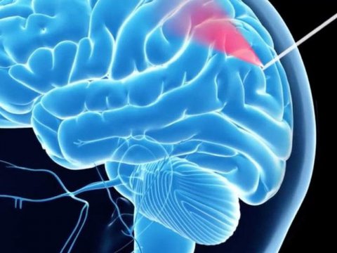 Beyin biopsiyası üçün kameralı "ağıllı" iynə yaradılıb